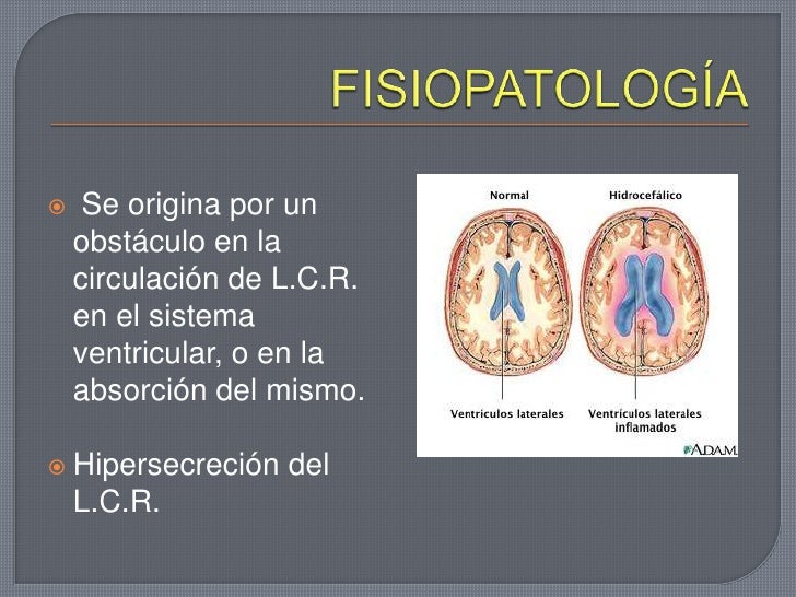 fisiopatologia siringomielia